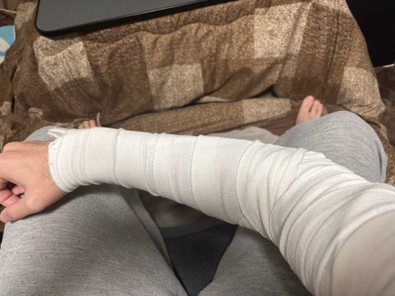 右腕をギプスと包帯で固定